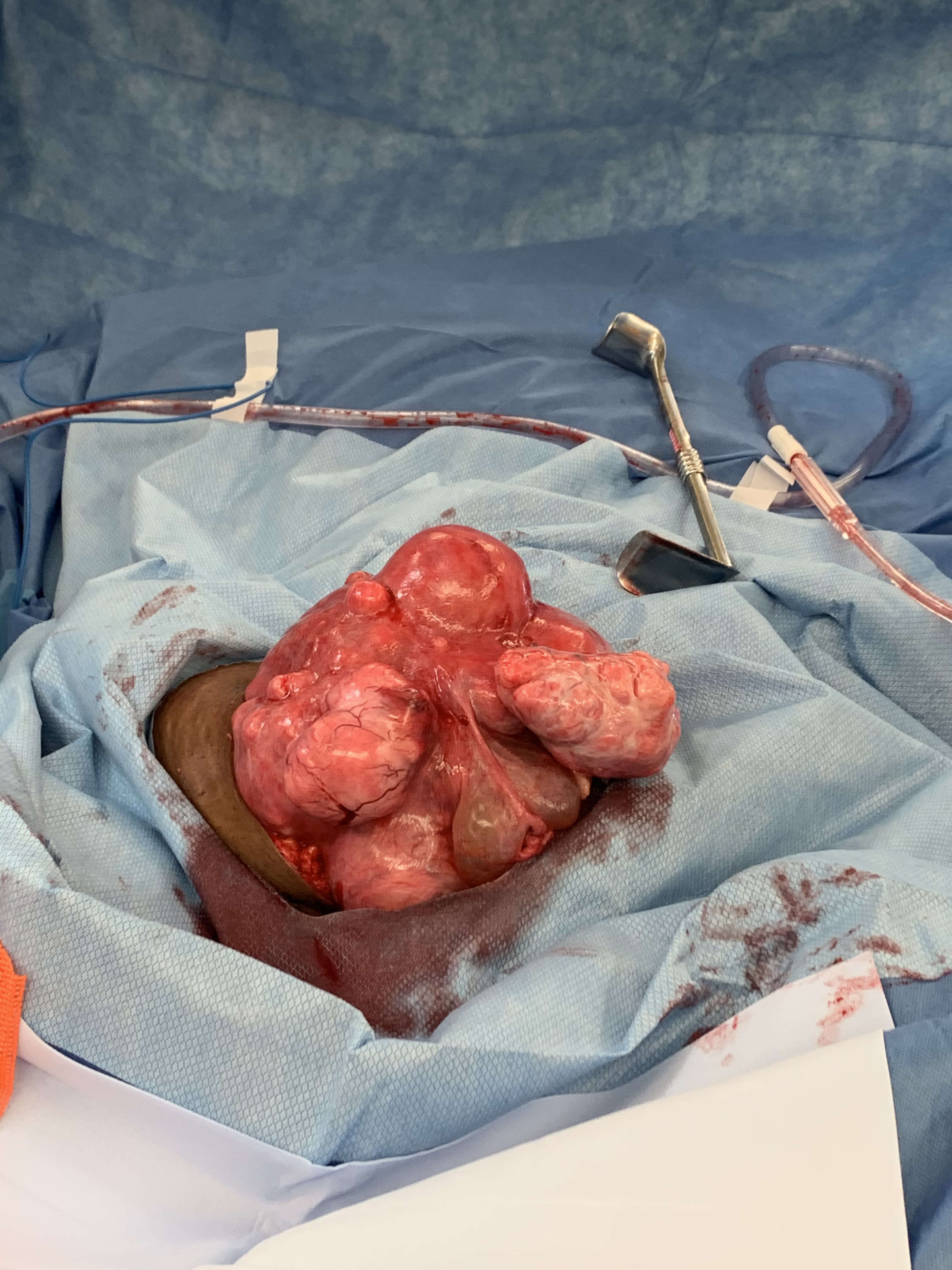 Uterine fibroids exposed during surgery