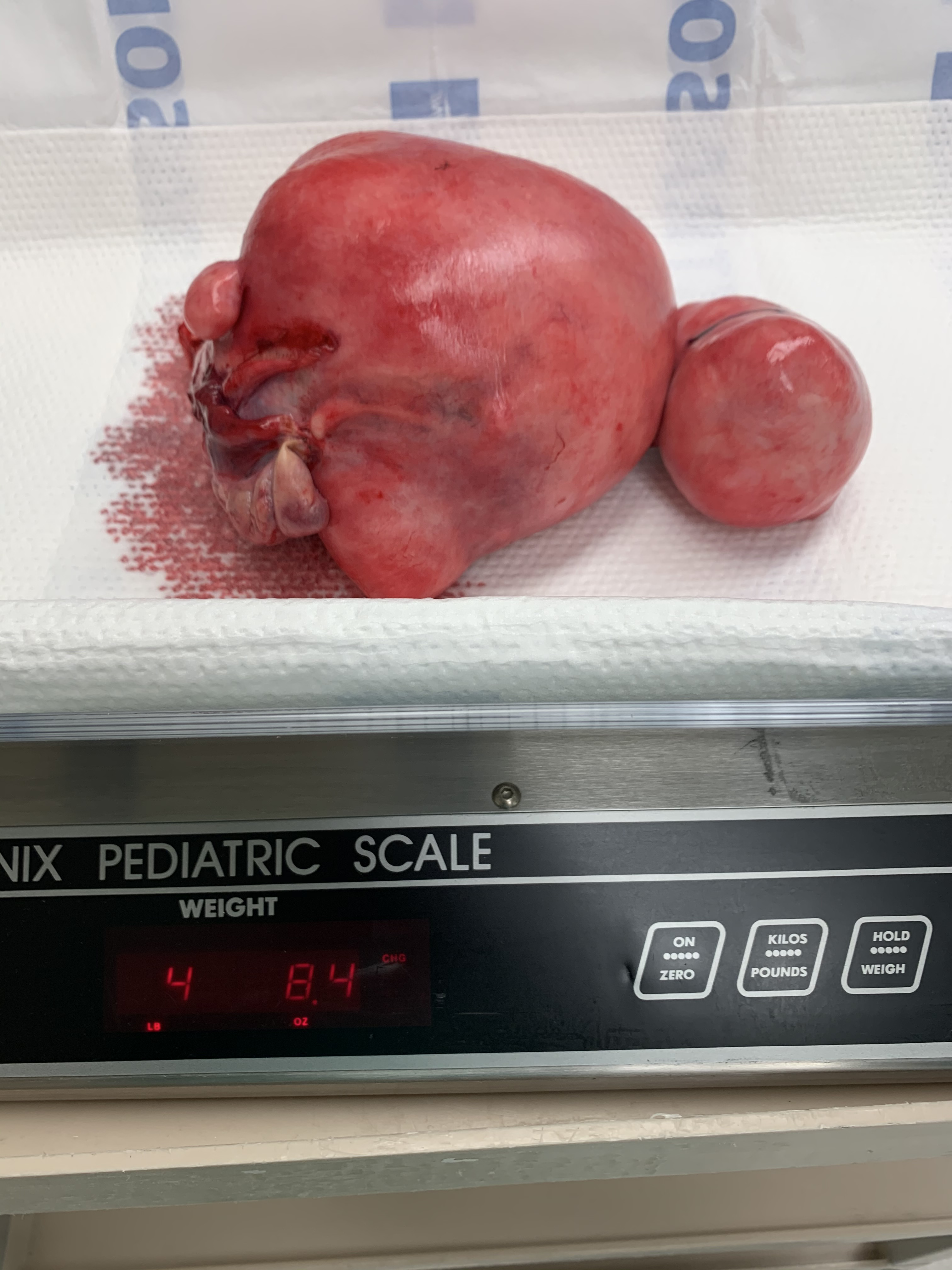 Uterine fibroids getting weighed