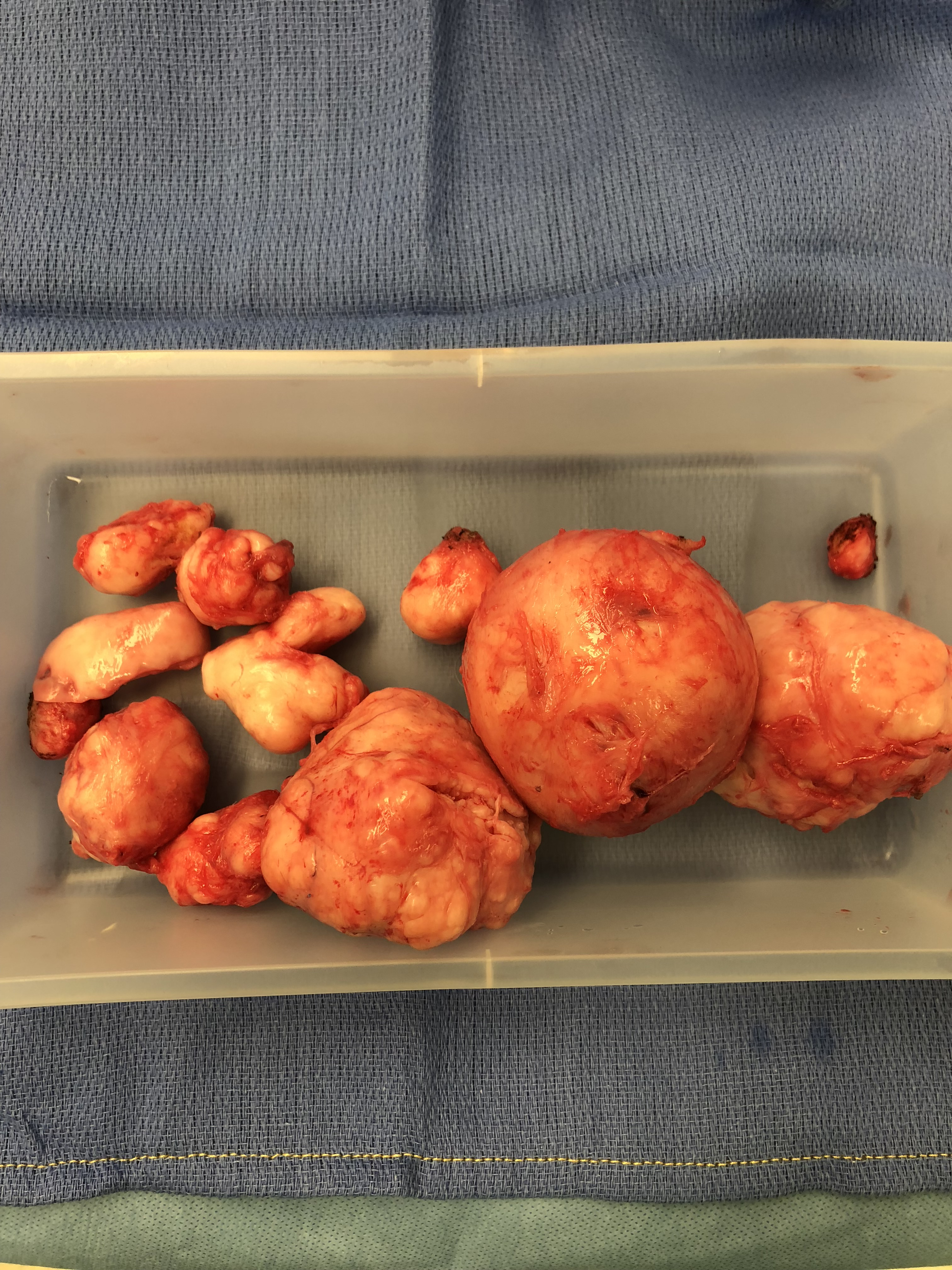 Uterine fibroids collected in a container