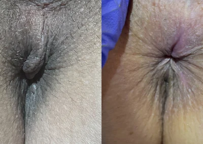 Anal Skin Tag Removal before and after photos by The Cosmetic Gyn: Dr. Michael Reed in Davis, CA