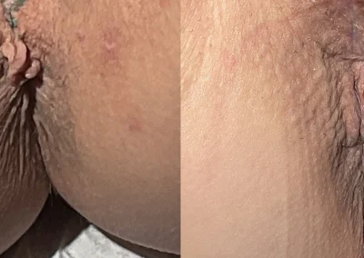 Anal Skin Tag Removal before and after photos by The Cosmetic Gyn: Dr. Michael Reed in Davis, CA