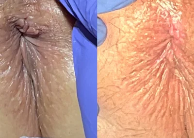 Anal Skin Tag Removal before and after photos by The Cosmetic Gyn: Dr. Michael Reed in Davis, CA