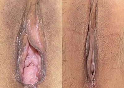 Vaginoplasty and Perineoplasty before and after photos by The Cosmetic Gyn: Dr. Michael Reed in Davis, CA