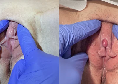 Clitoral Unhooding before and after photos by The Cosmetic Gyn: Dr. Michael Reed in Davis, CA