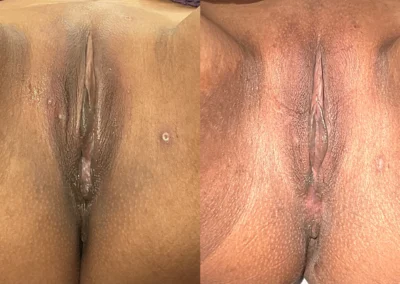 Vaginoplasty and Perineoplasty before and after photos by The Cosmetic Gyn: Dr. Michael Reed in Davis, CA