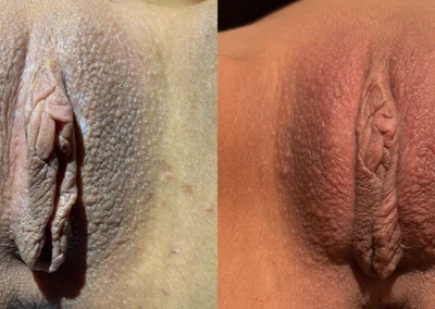 Vampire Lift before and after photos by The Cosmetic Gyn: Dr. Michael Reed in Davis, CA