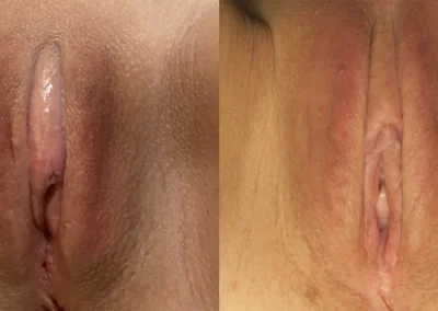 Clitoral Unhooding before and after photos by The Cosmetic Gyn: Dr. Michael Reed in Davis, CA