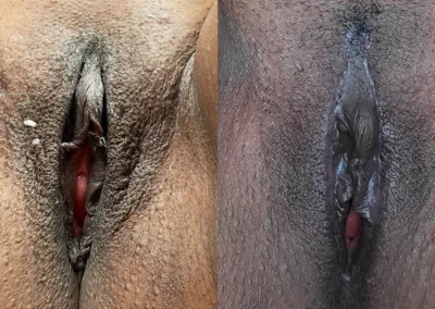 Labia Majoraplasty before and after photos by The Cosmetic Gyn: Dr. Michael Reed in Davis, CA