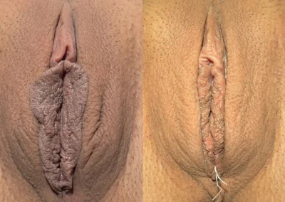 Labiaplasty before and after photos by The Cosmetic Gyn: Dr. Michael Reed in Davis, CA