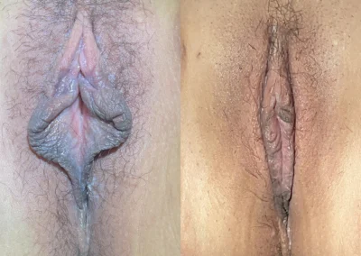 Labiaplasty before and after photos by The Cosmetic Gyn: Dr. Michael Reed in Davis, CA