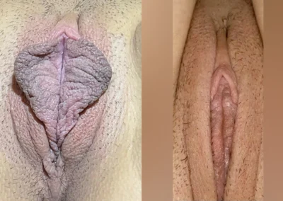 Labiaplasty before and after photos by The Cosmetic Gyn: Dr. Michael Reed in Davis, CA