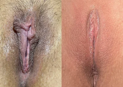 Labiaplasty before and after photos by The Cosmetic Gyn: Dr. Michael Reed in Davis, CA