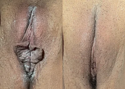 Labiaplasty before and after photos by The Cosmetic Gyn: Dr. Michael Reed in Davis, CA