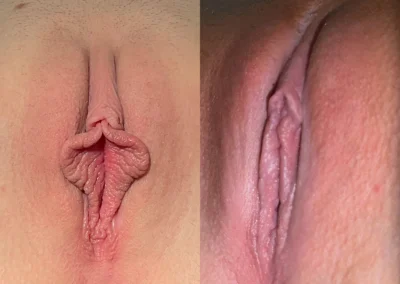 Labiaplasty before and after photos by The Cosmetic Gyn: Dr. Michael Reed in Davis, CA