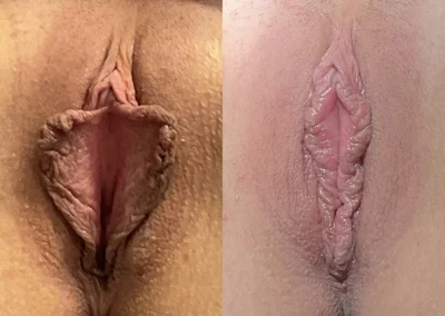 Labiaplasty before and after photos by The Cosmetic Gyn: Dr. Michael Reed in Davis, CA