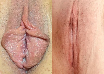 Labiaplasty before and after photos by The Cosmetic Gyn: Dr. Michael Reed in Davis, CA