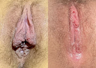 Labiaplasty before and after photos by The Cosmetic Gyn: Dr. Michael Reed in Davis, CA