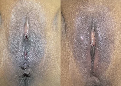 Vaginoplasty and Perineoplasty before and after photos by The Cosmetic Gyn: Dr. Michael Reed in Davis, CA