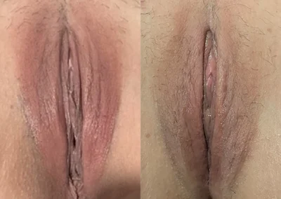 Vaginoplasty and Perineoplasty before and after photos by The Cosmetic Gyn: Dr. Michael Reed in Davis, CA