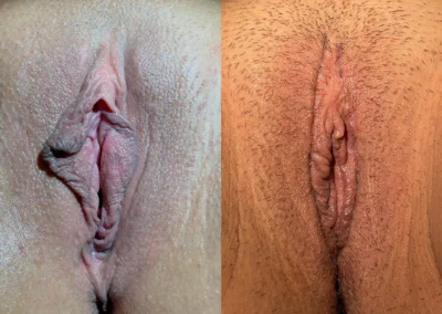 Combination Procedures before and after photos by The Cosmetic Gyn Dr. Michael Reed in Davis, CA