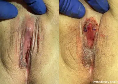 Clitoral Unhooding before and after photos by The Cosmetic Gyn Dr. Michael Reed in Davis, CA