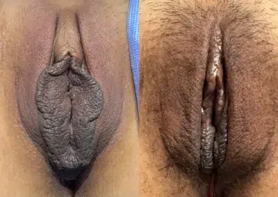 Labiaplasty before and after photos by The Cosmetic Gyn Dr. Michael Reed in Davis, CA