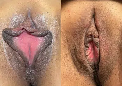 Labiaplasty before and after photos by The Cosmetic Gyn Dr. Michael Reed in Davis, CA