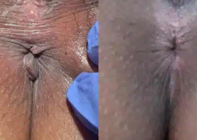 Anal Skin Tag Removal before and after photos by Dr. Michael Reed