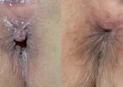 Anal Skin Tag Removal before and after photos by Dr. Michael Reed