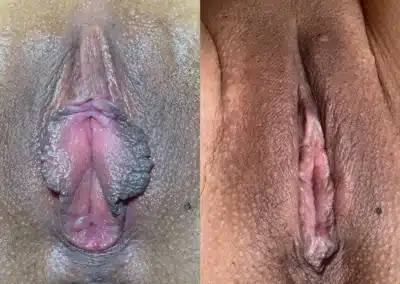 Labiaplasty before and after photos by Dr. Michael Reed
