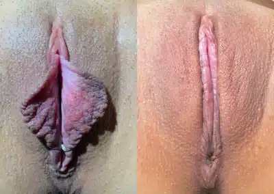 Labiaplasty before and after photos by Dr. Michael Reed