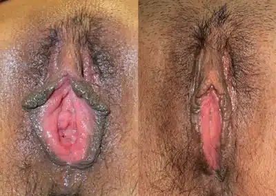Labiaplasty before and after photos by Dr. Michael Reed