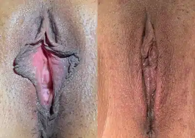 Labiaplasty before and after photos by Dr. Michael Reed