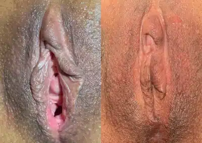 Vaginoplasty + Perineoplasty before and after photos by Dr. Michael Reed