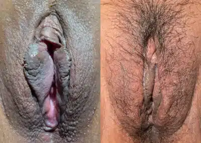 Vaginoplasty + Perineoplasty before and after photos by Dr. Michael Reed