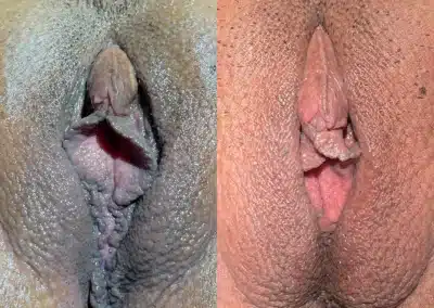 Vaginoplasty + Perineoplasty before and after photos by Dr. Michael Reed